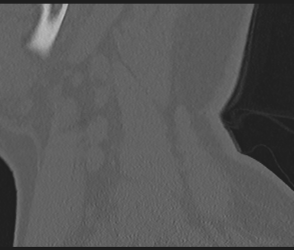 Cervical disc replacement (Radiopaedia 44025-47541 Sagittal bone window 10).png
