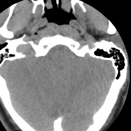 Cervical schwannoma (Radiopaedia 57979-64974 Axial non-contrast 7).png