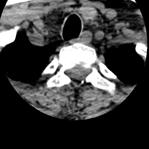 File:Cervical spinal neurofibroma in a patient with NF1 (Radiopaedia 58344-65464 Axial non-contrast 73).jpg