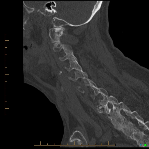 File:Cervical spine fracture - ankylosing spondylitis (Radiopaedia 76835-88706 Sagittal bone window 37).jpg