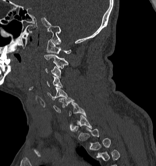 Cervical spine trauma with tear drop fracture and perched facet joint (Radiopaedia 53989-60127 Sagittal bone window 122).jpg