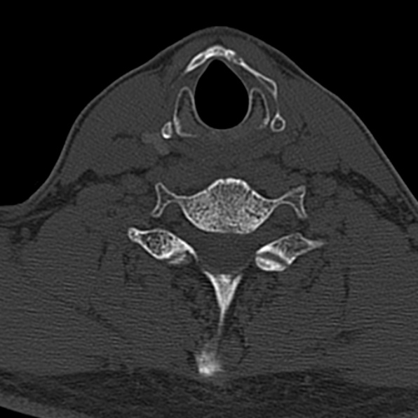 Cervical spondylodiscitis (Radiopaedia 28057-29489 Axial bone window 56).jpg