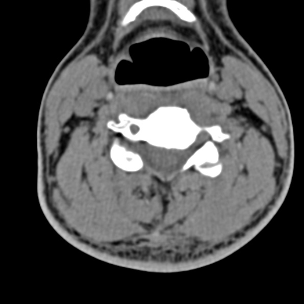 Cervical spondylodiscitis (Radiopaedia 28057-29489 Axial non-contrast 41).jpg