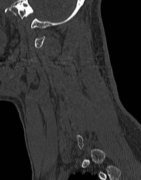Cervical spondylodiscitis (Radiopaedia 28057-29489 Sagittal bone window 17).jpg
