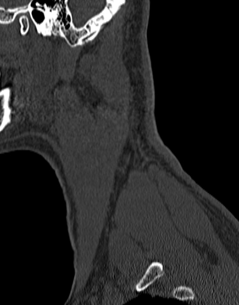 Cervical spondylodiscitis (Radiopaedia 28057-29489 Sagittal bone window 8).jpg