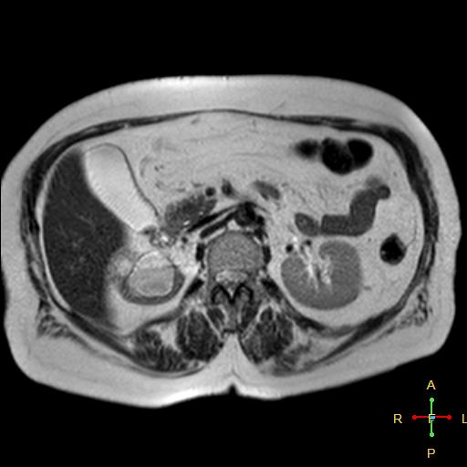 File:Cervical stump squamous cell carcinoma (Radiopaedia 48049-52858 I 6).jpg