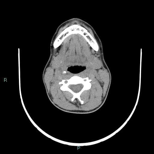 File:Cervical thymic cyst (Radiopaedia 88632-105335 Axial non-contrast 70).jpg