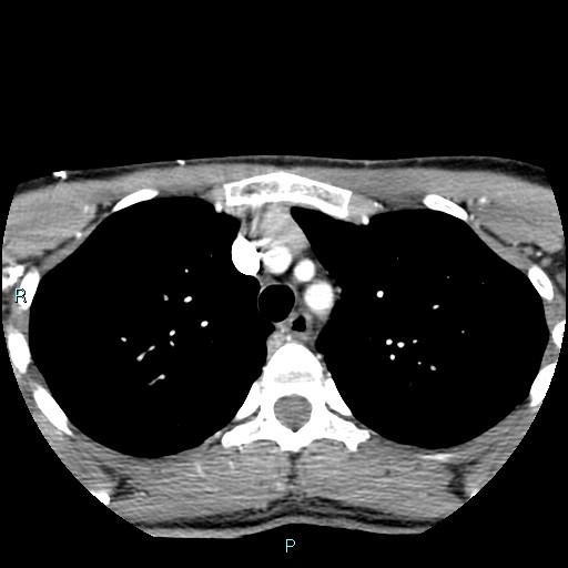 Cervical thymic cyst (Radiopaedia 88632-105335 B 4).jpg
