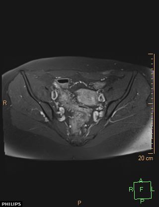 File:Cesarian scar endometriosis (Radiopaedia 68495-78066 Axial T1 C+ fat sat 9).jpg