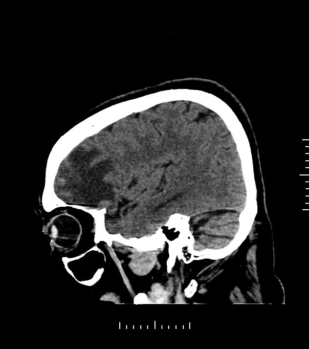 Cholangiocarcinoma with cerebral metastases (Radiopaedia 83519-98628 C 42).jpg