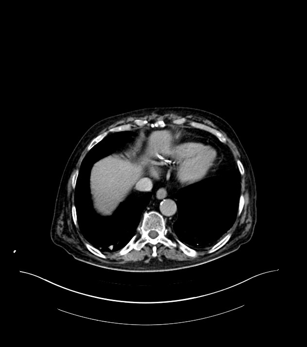 Cholangiocarcinoma with cerebral metastases (Radiopaedia 83519-98629 Axial C+ delayed 9).jpg