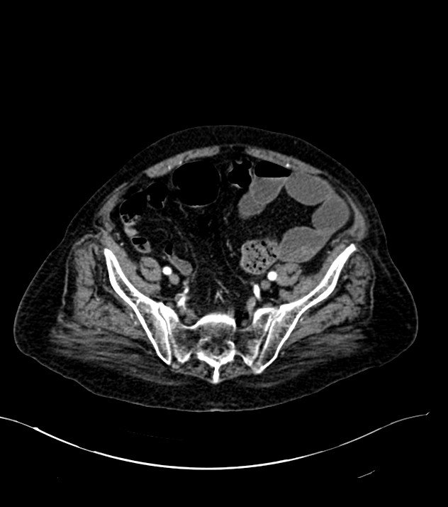 Cholangiocarcinoma with cerebral metastases (Radiopaedia 83519-98629 B 97).jpg