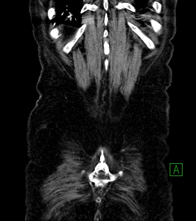 Cholangiocarcinoma with cerebral metastases (Radiopaedia 83519-98629 E 80).jpg