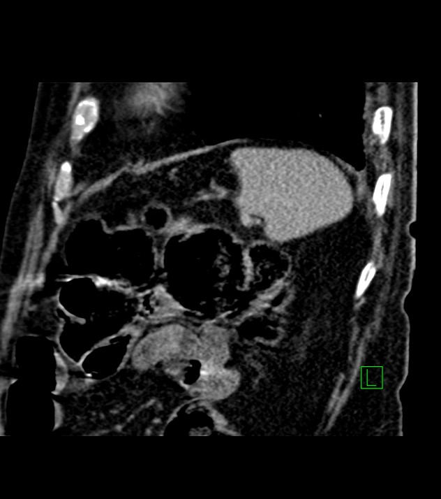 Cholangiocarcinoma with cerebral metastases (Radiopaedia 83519-98629 Sagittal C+ delayed 23).jpg