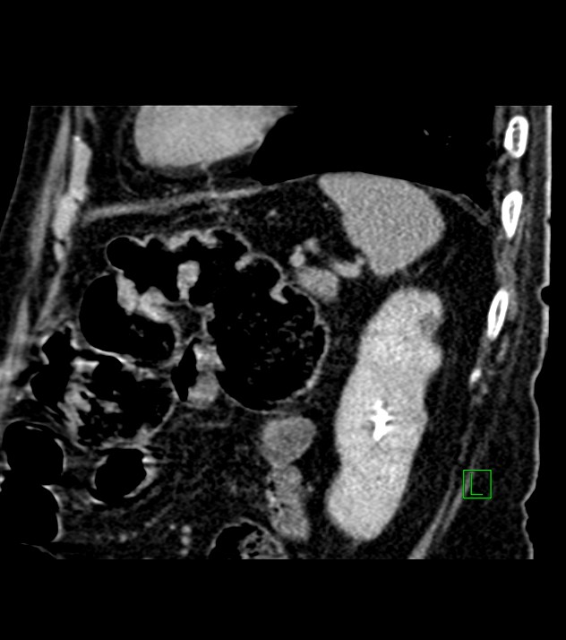 Cholangiocarcinoma with cerebral metastases (Radiopaedia 83519-98629 Sagittal C+ delayed 29).jpg