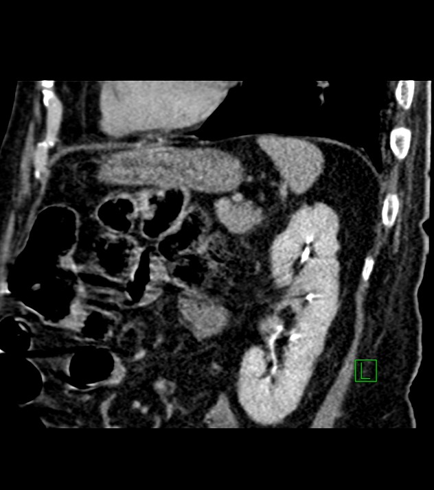 Cholangiocarcinoma with cerebral metastases (Radiopaedia 83519-98629 Sagittal C+ delayed 34).jpg