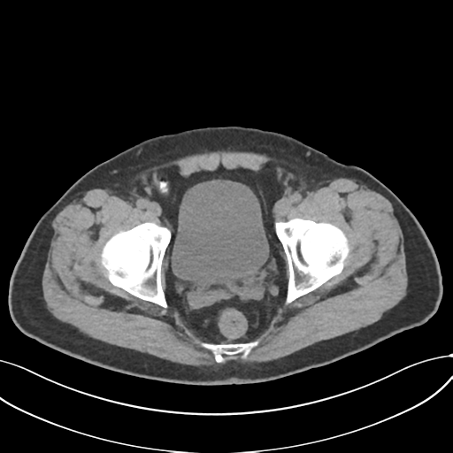 Cholecystitis with focal perforation and hepatic abscess (Radiopaedia 37189-38945 Axial non-contrast 79).png