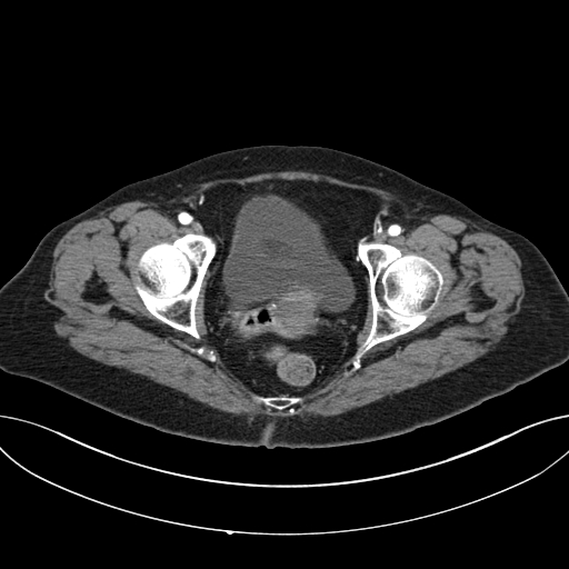 Cholecystoduodenal fistula due to calculous cholecystitis with gallstone migration (Radiopaedia 86875-103077 A 68).jpg