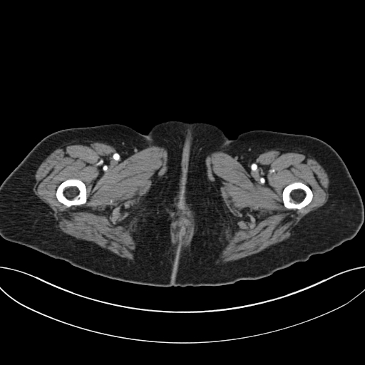 Cholecystoduodenal fistula due to calculous cholecystitis with gallstone migration (Radiopaedia 86875-103077 A 84).jpg
