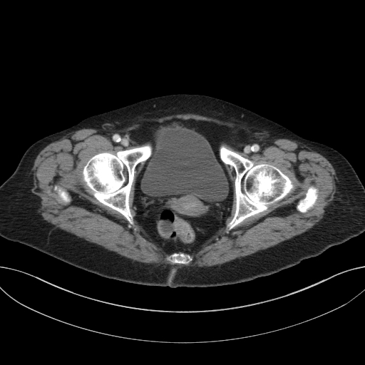 Cholecystoduodenal fistula due to calculous cholecystitis with gallstone migration (Radiopaedia 86875-103077 D 76).jpg