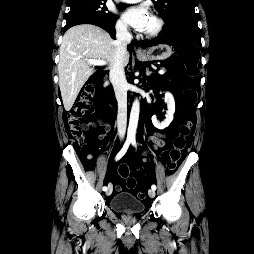 Choledocholiathiasis with normal caliber common bile duct (Radiopaedia 75368-86632 Coronal liver window 65).jpg