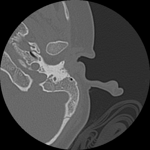 Cholesteatoma (Radiopaedia 73023-83750 Axial Left ear 8).jpg