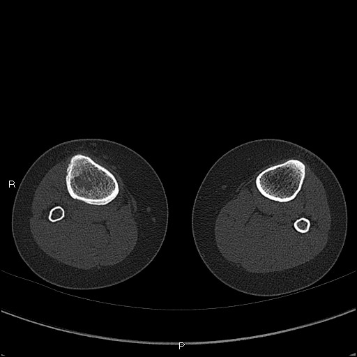 File:Chondroblastoma (Radiopaedia 62721-71030 Axial bone window 98).jpg