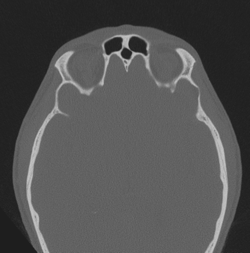 Chondrosarcoma (clivus) (Radiopaedia 46895-51425 Axial bone window 12).png