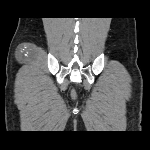 Chondrosarcoma of iliac wing (Radiopaedia 63861-72599 Coronal non-contrast 95).jpg