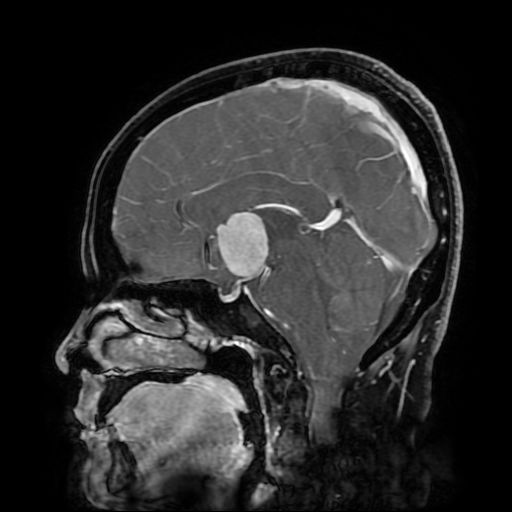 File:Chordoid glioma of third ventricle (Radiopaedia 91612-109340 F 109).jpg