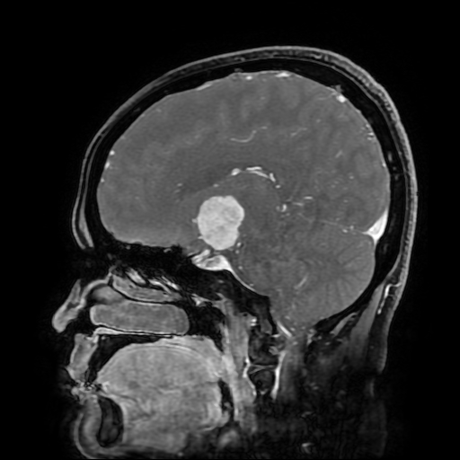 File:Chordoid glioma of third ventricle (Radiopaedia 91612-109340 F 96).jpg