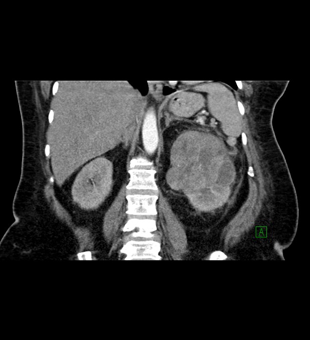 Chromophobe renal cell carcinoma (Radiopaedia 84239-99519 C 58).jpg