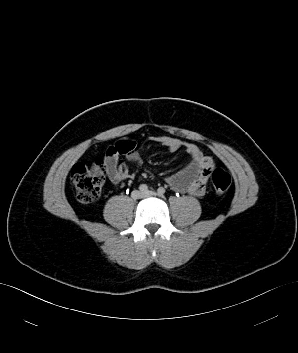 Chromophobe renal cell carcinoma (Radiopaedia 84255-99542 H 31).jpg