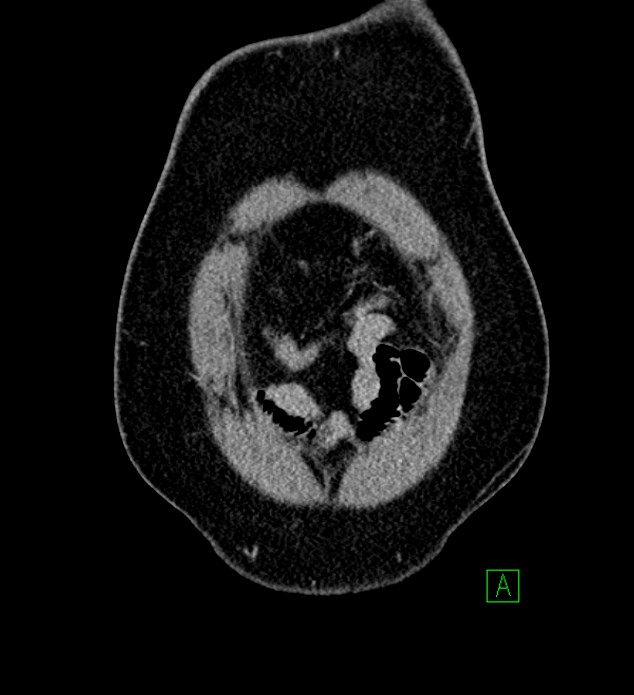 Chromophobe renal cell carcinoma (Radiopaedia 84286-99573 H 14).jpg