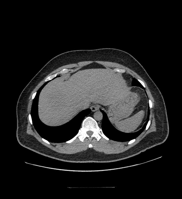Chromophobe renal cell carcinoma (Radiopaedia 84337-99644 Axial non-contrast 11).jpg