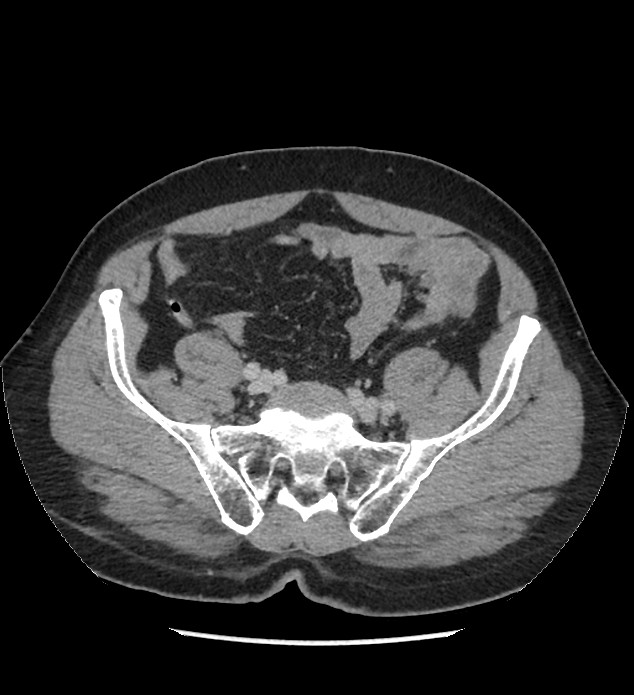 Chromophobe renal cell carcinoma (Radiopaedia 86879-103083 C 115).jpg