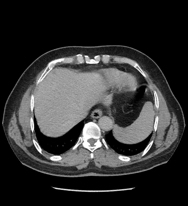 Chromophobe renal cell carcinoma (Radiopaedia 86879-103083 D 12).jpg