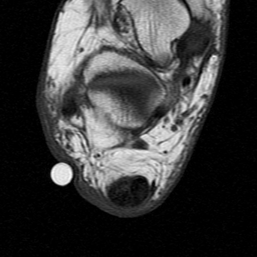 File:Chronic Achilles tendon rupture (Radiopaedia 15262-15100 Axial T1 19).jpg