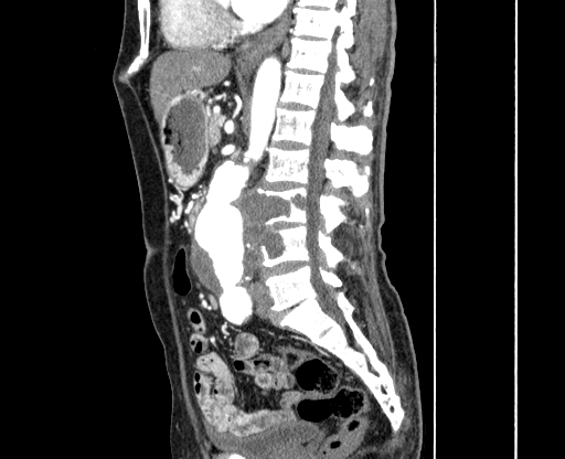 Chronic contained rupture of abdominal aortic aneurysm with extensive erosion of the vertebral bodies (Radiopaedia 55450-61901 B 32).jpg