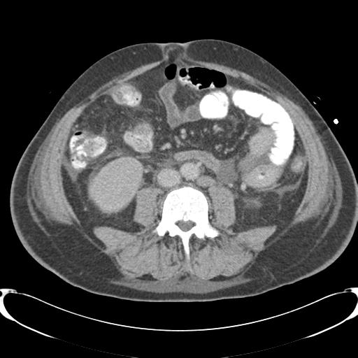 Chronic diverticulitis complicated by hepatic abscess and portal vein thrombosis (Radiopaedia 30301-30938 A 55).jpg