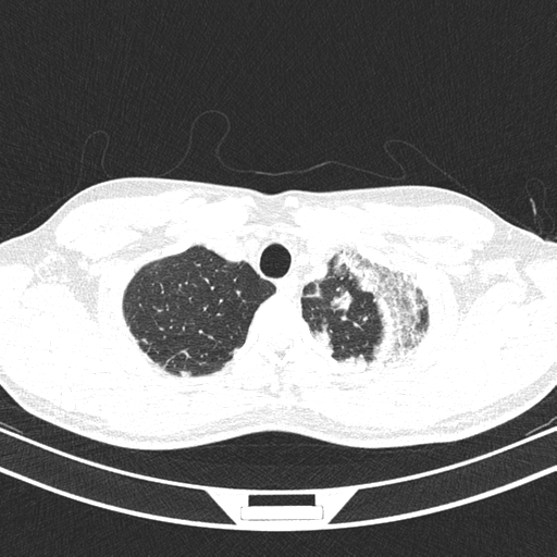 Chronic eosinophilic pneumonia (Radiopaedia 39331-41587 Axial lung window 7).png
