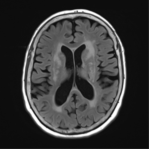 File:Chronic hypertensive encephalopathy (Radiopaedia 39993-42482 Axial FLAIR 16).png