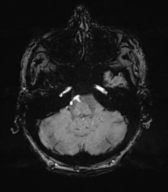 Chronic hypertensive encephalopathy (Radiopaedia 39993-42482 Axial SWI 17).png