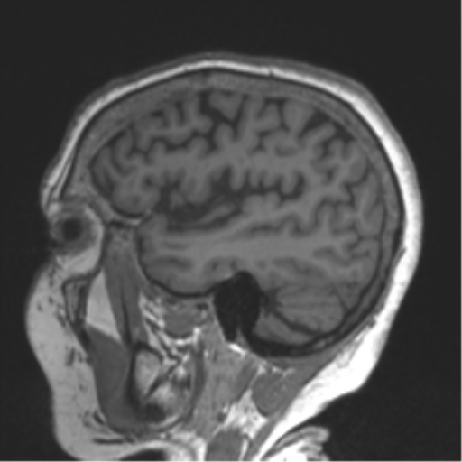 Chronic hypertensive encephalopathy (Radiopaedia 39993-42482 Sagittal T1 71).png
