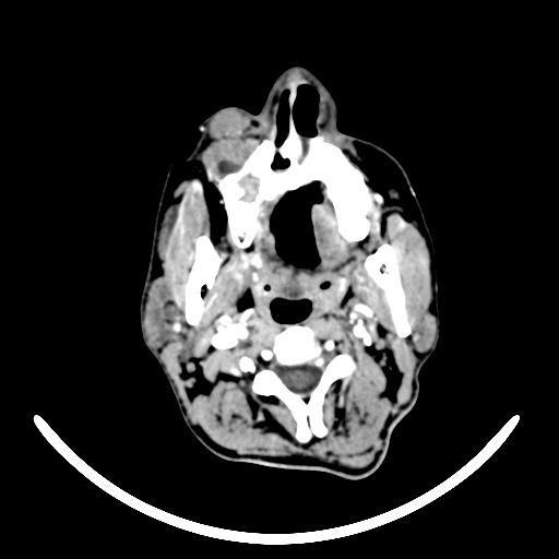 Chronic invasive fungal sinusitis with intraorbital and intracranial extension (Radiopaedia 56387-63046 B 3).jpg