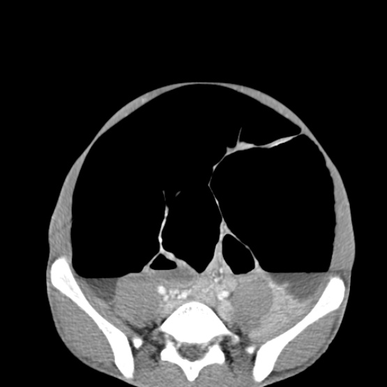 Chronic large bowel pseudo-obstruction (Radiopaedia 43181-46492 A 123).jpg