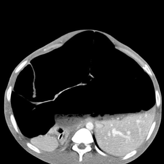 Chronic large bowel pseudo-obstruction (Radiopaedia 43181-46492 A 53).jpg