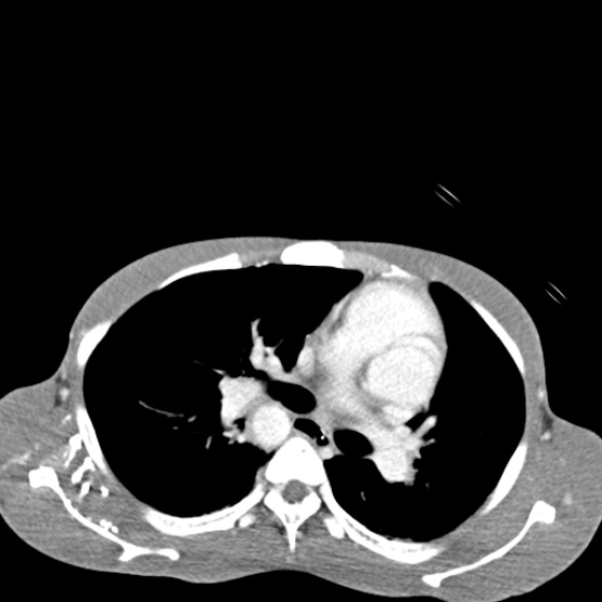 Chronic large bowel pseudo-obstruction (Radiopaedia 43181-46492 A 8).jpg