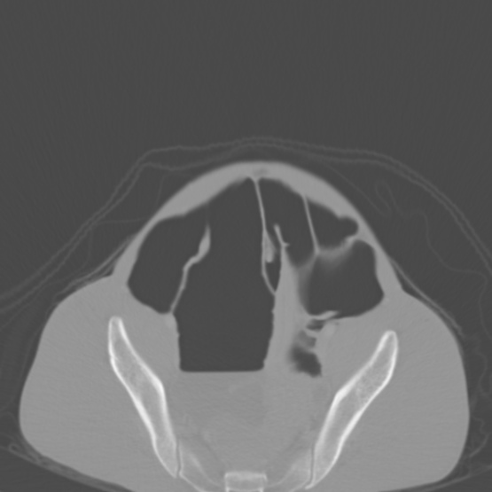 Chronic large bowel pseudo-obstruction (Radiopaedia 43181-46492 Axial bone window 141).jpg