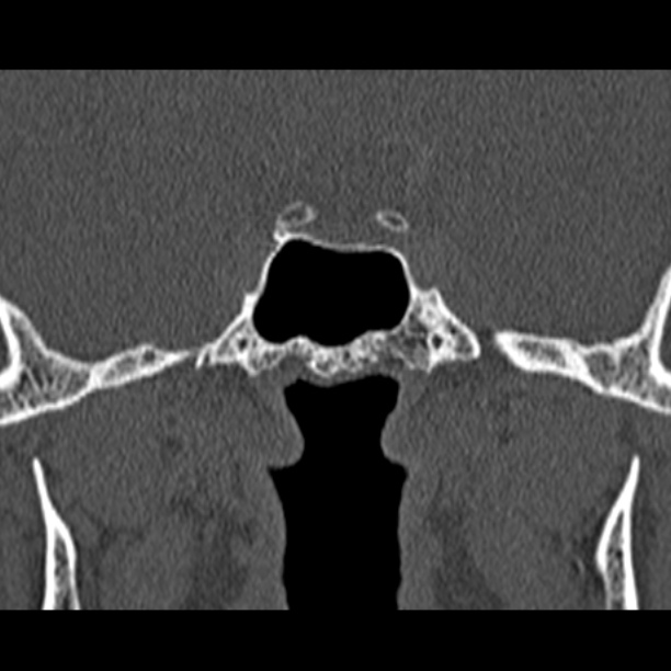 Chronic maxillary sinusitis (Radiopaedia 27879-28116 Coronal bone window 51).jpg